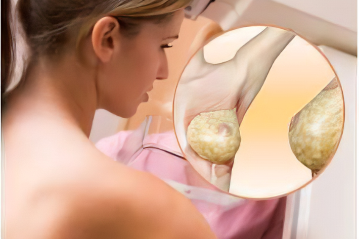 Hertraz 150mg: How This Targeted Therapy Helps Fight Breast Cancer